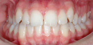 From corticotomy to regenerative orthodontics