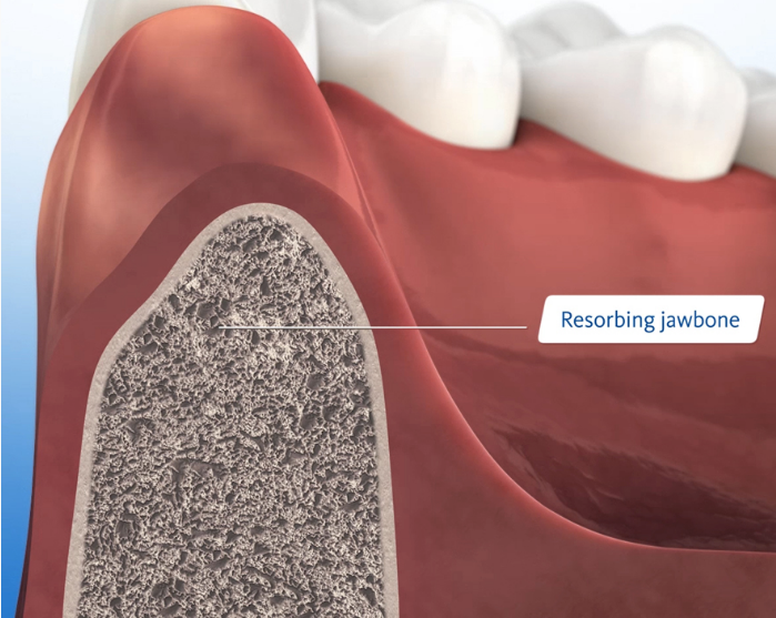 Tooth Extraction Ridge Dentoalveolar ridge preservation after tooth extraction: biology – The ...