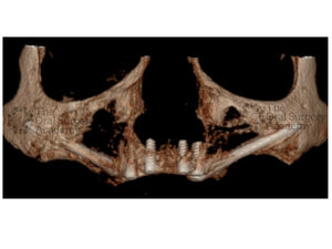 Zygomatic implants in maxillary atrophic patients: the 5 techniques you should know about.